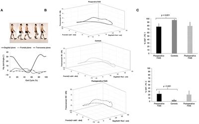 Hip Joint Kinematic Covariation During Gait Before and 1-Year After Hip Arthroscopic Surgery for Femoroacetabular Impingement Syndrome